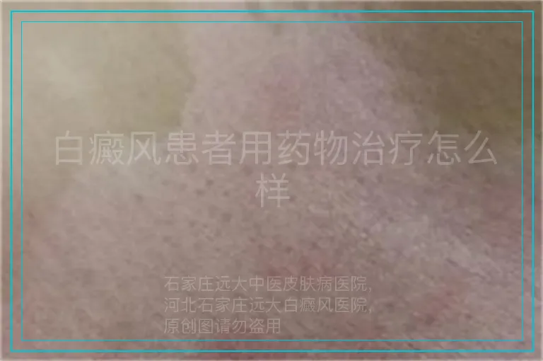 白癜风患者用药物治疗怎么样