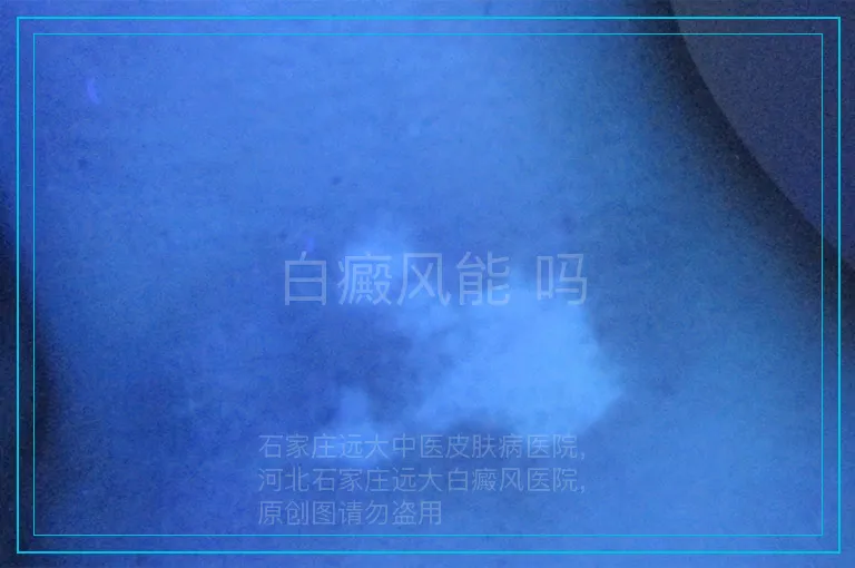白癜风能 吗