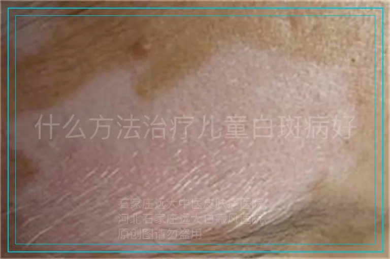 什么方法治疗儿童白斑病好