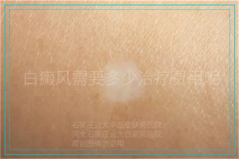 白癜风需要多少治疗费用呢
