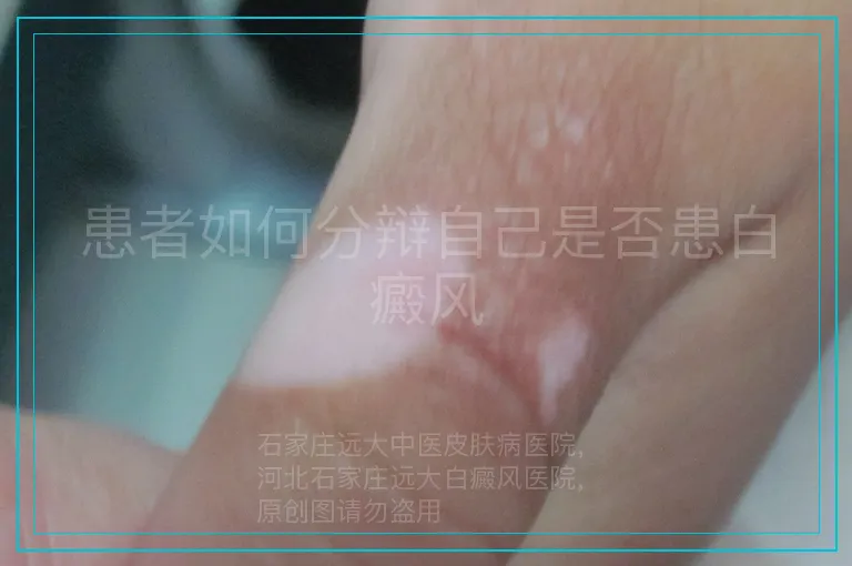 患者如何分辩自己是否患白癜风