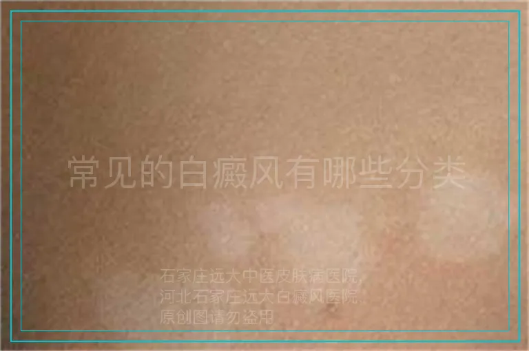 常见的白癜风有哪些分类
