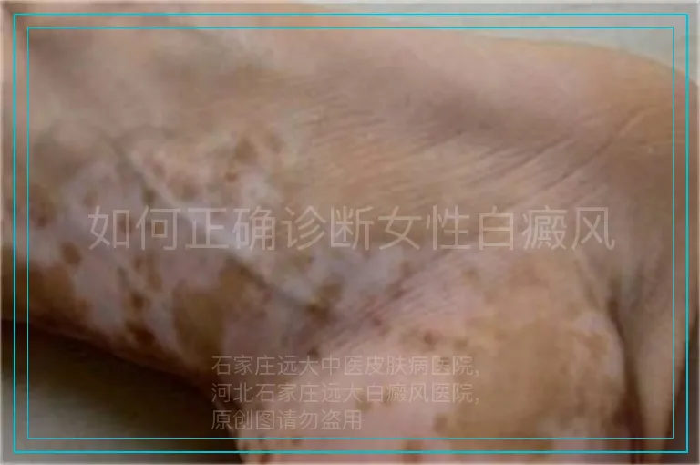 如何正确诊断女性白癜风