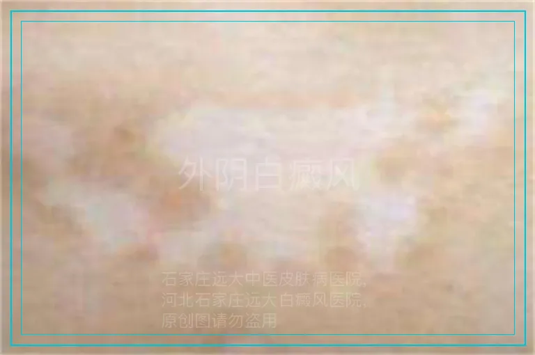 外阴白癜风