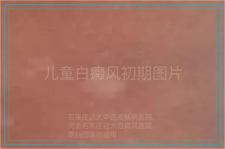 儿童白癜风初期图片