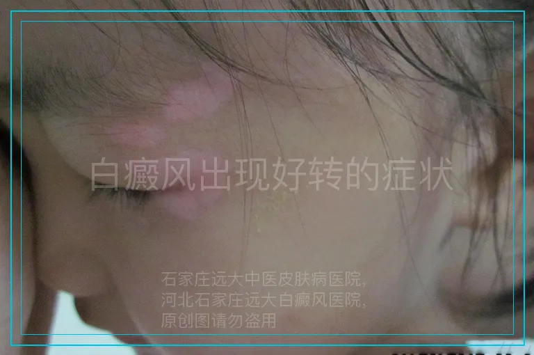 白癜风出现好转的症状