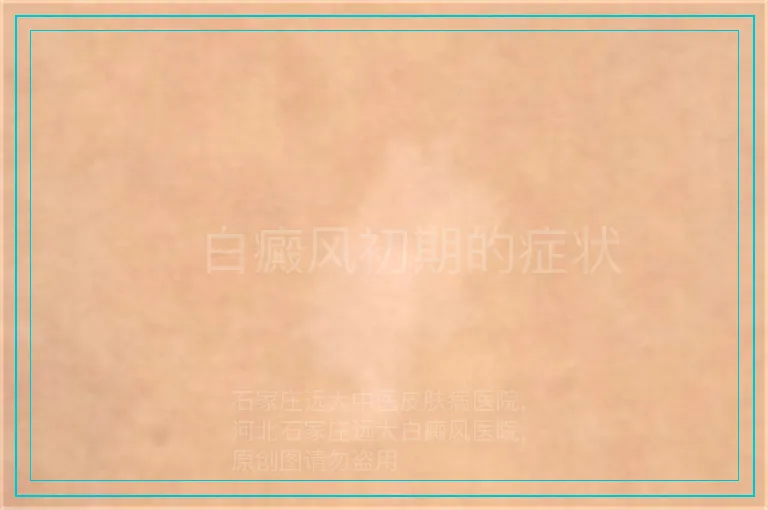 　白癜风初期的症状