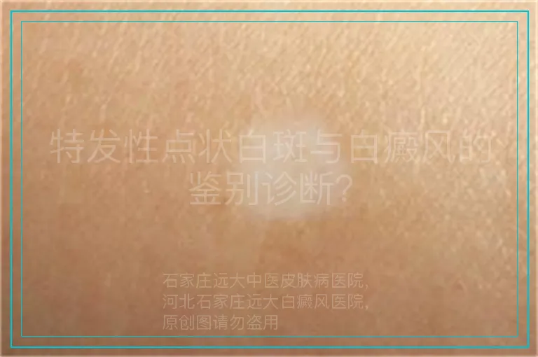 特发性点状白斑与白癜风的鉴别诊断？
