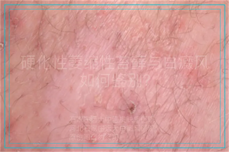 硬化性萎缩性苔藓与白癜风如何鉴别？