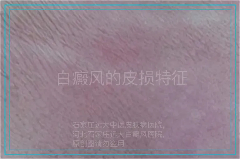 白癜风的皮损特征