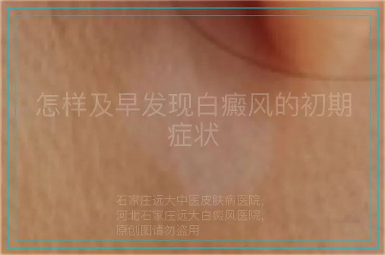怎样及早发现白癜风的初期症状