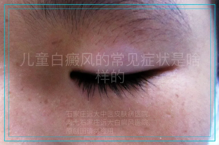 儿童白癜风的常见症状是啥样的