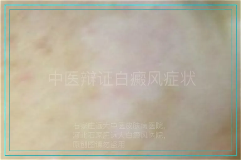 中医辩证白癜风症状