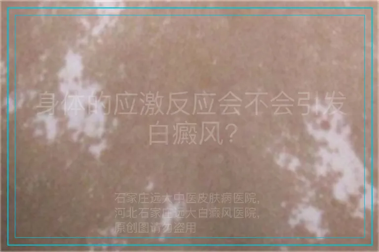 身体的应激反应会不会引发白癜风?