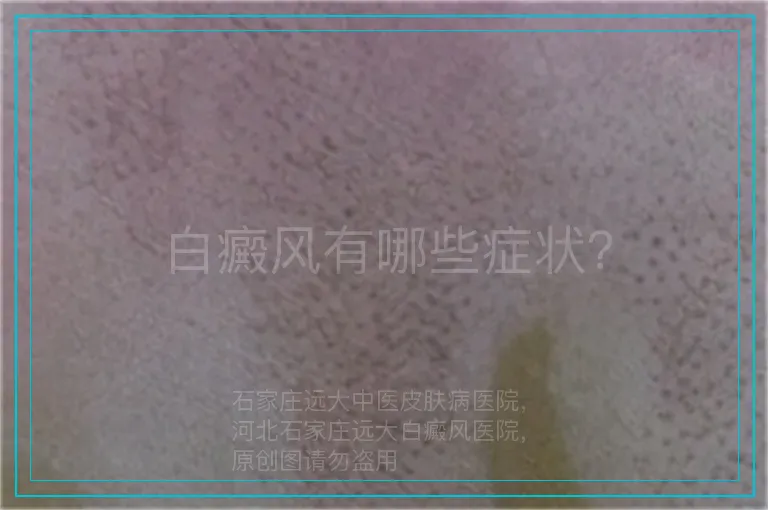 白癜风有哪些症状？