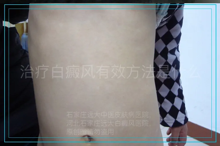 治疗白癜风有效方法是什么