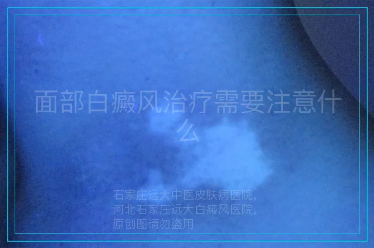 面部白癜风治疗需要注意什么