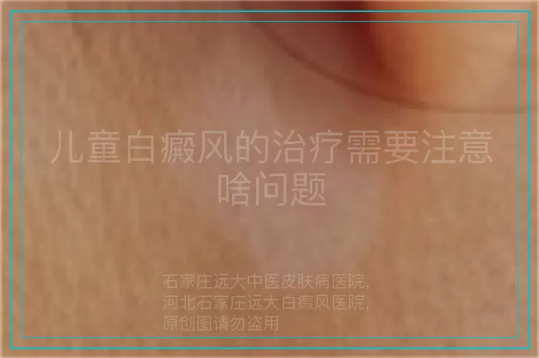 儿童白癜风的治疗需要注意啥问题