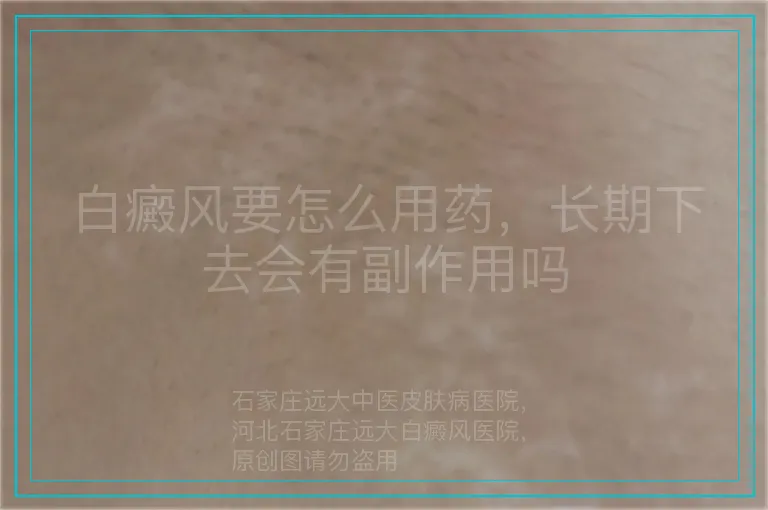 白癜风要怎么用药,长期下去会有副作用吗