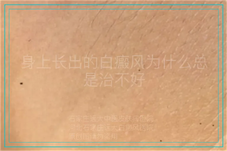 身上长出的白癜风为什么总是治不好