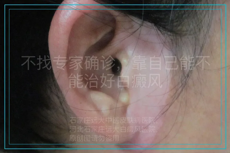 不找专家确诊,靠自己能不能治好白癜风