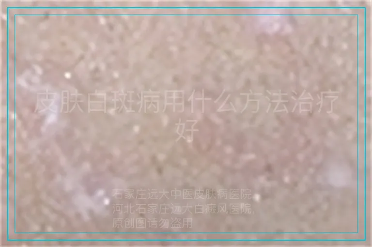 皮肤白斑病用什么方法治疗好