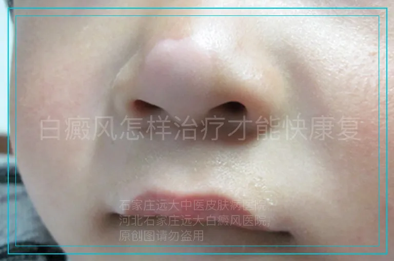 白癜风怎样治疗才能快康复