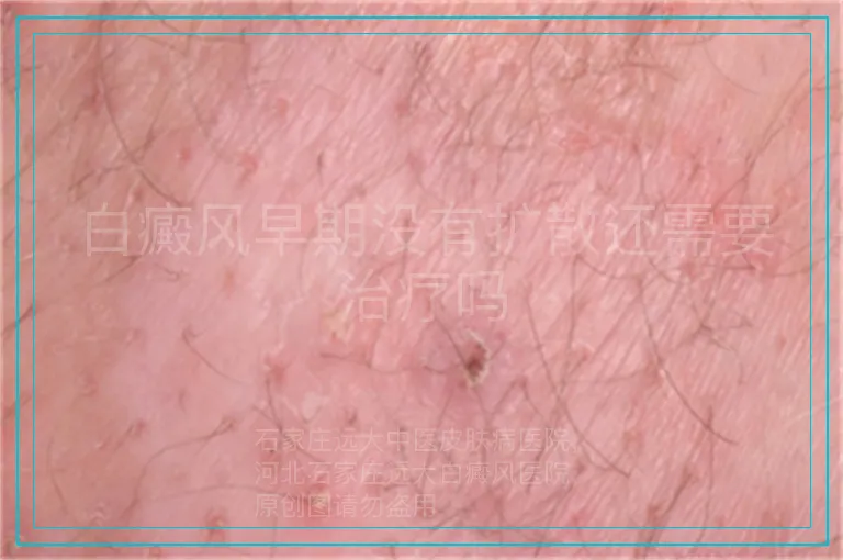 白癜风早期没有扩散还需要治疗吗