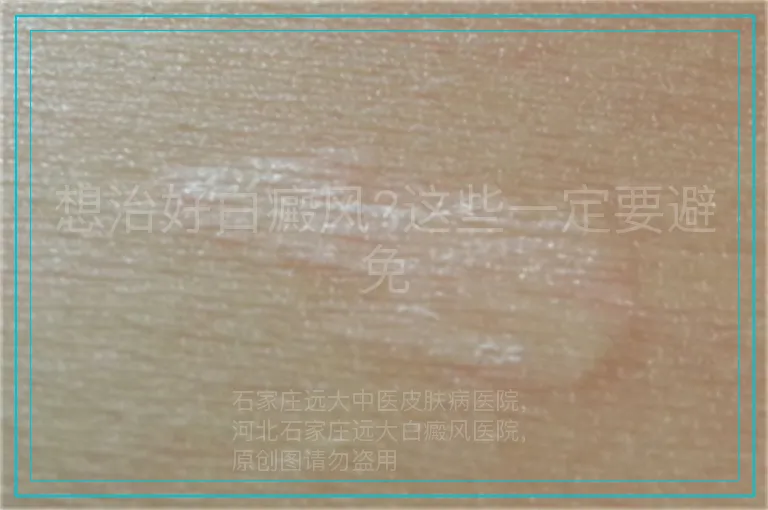 想治好白癜风?这些一定要避免