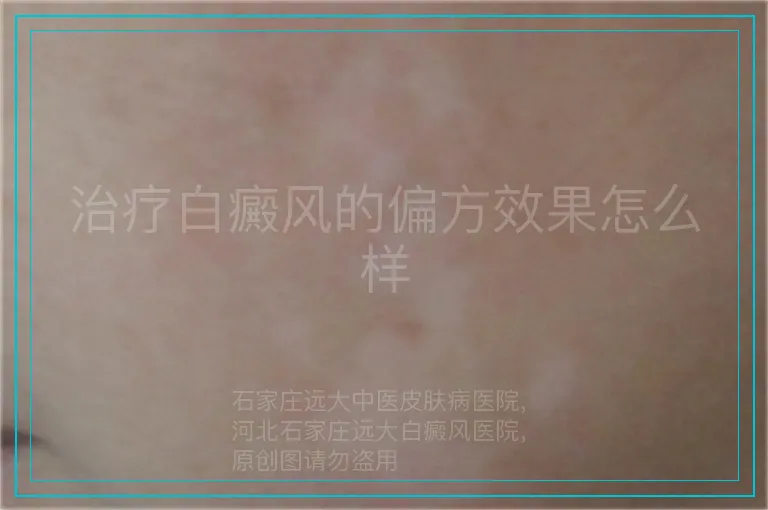 治疗白癜风的偏方效果怎么样