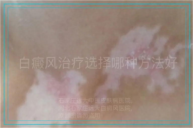 白癜风治疗选择哪种方法好