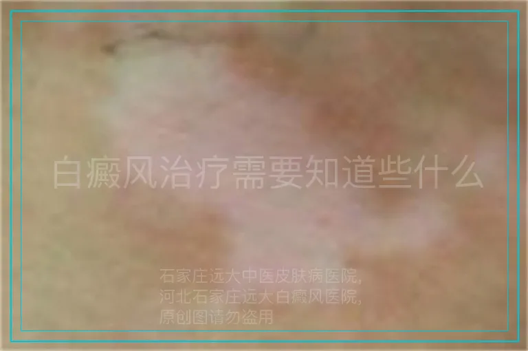 白癜风治疗需要知道些什么