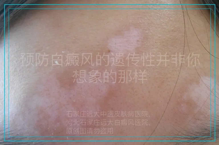 预防白癜风的遗传性并非你想象的那样