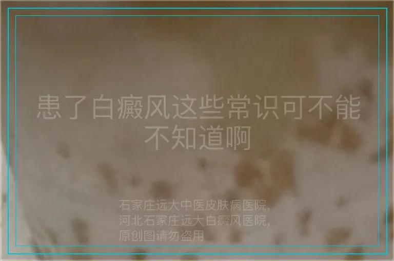 患了白癜风这些常识可不能不知道啊