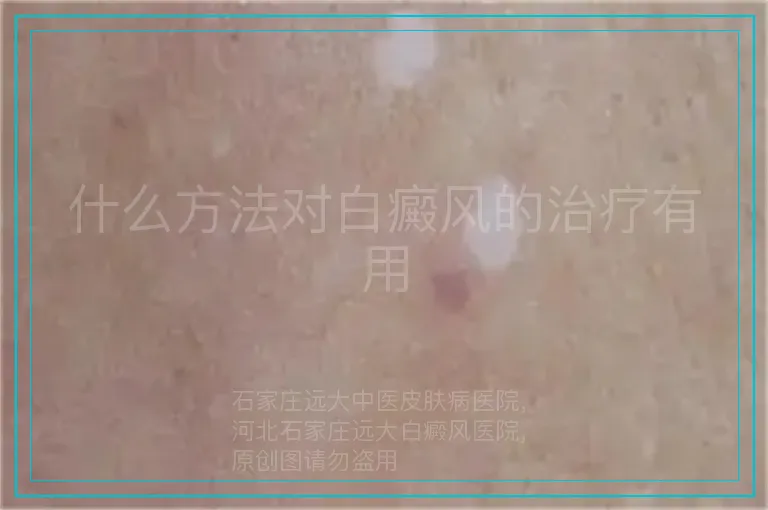 什么方法对白癜风的治疗有用