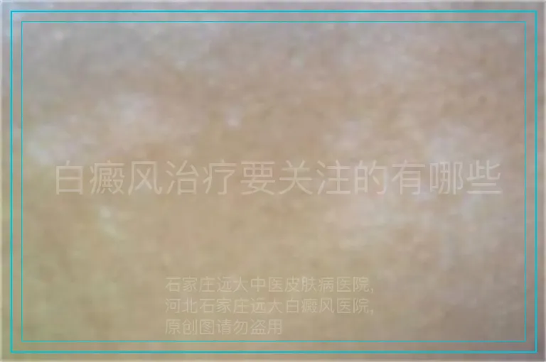 白癜风治疗要关注的有哪些