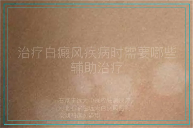治疗白癜风疾病时需要哪些辅助治疗