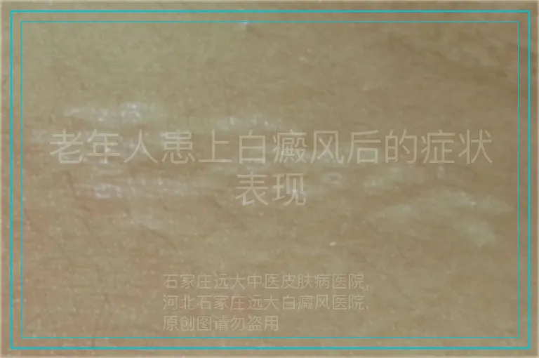 老年人患上白癜风后的症状表现