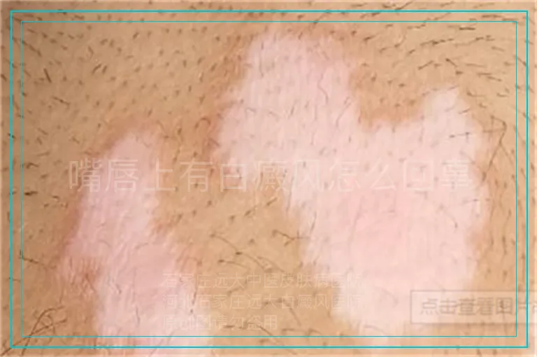 嘴唇上有白癜风怎么回事