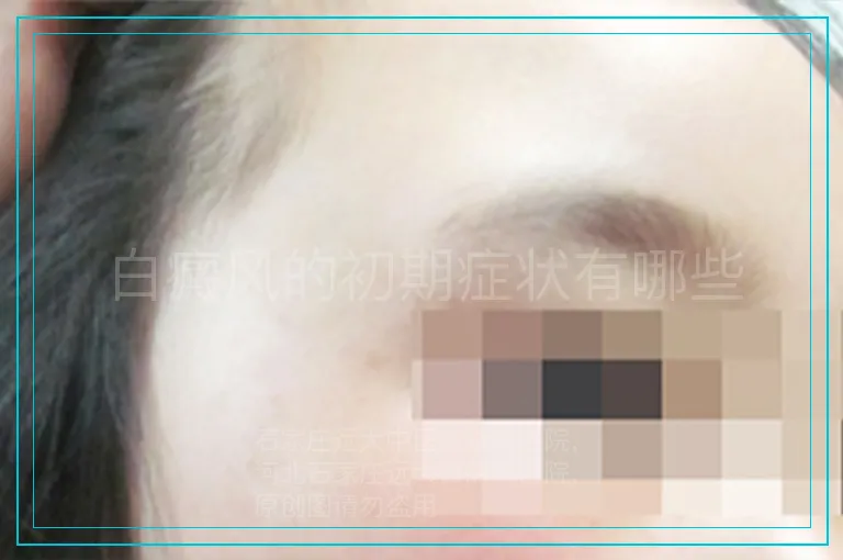 白癜风的初期症状有哪些