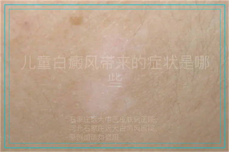 儿童白癜风带来的症状是哪些