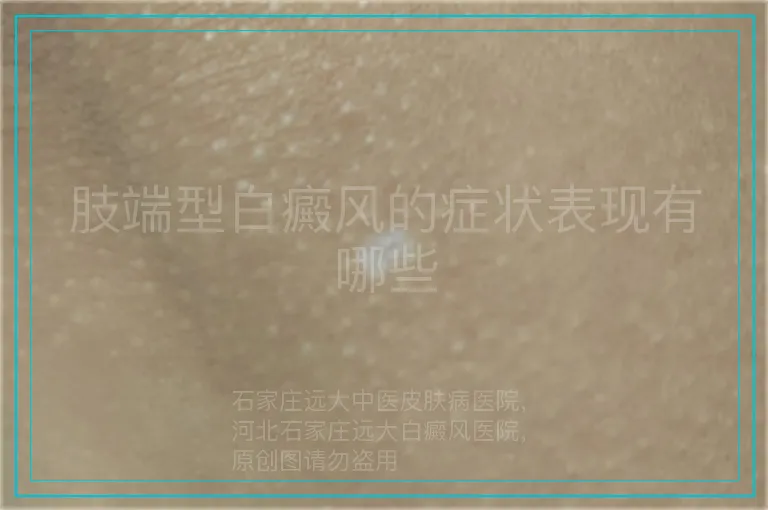 肢端型白癜风的症状表现有哪些