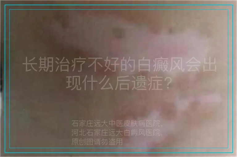 长期治疗不好的白癜风会出现什么后遗症?