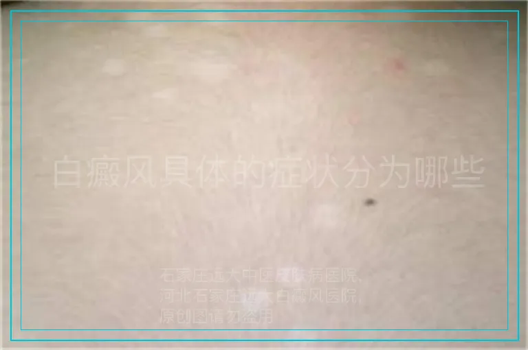 白癜风具体的症状分为哪些