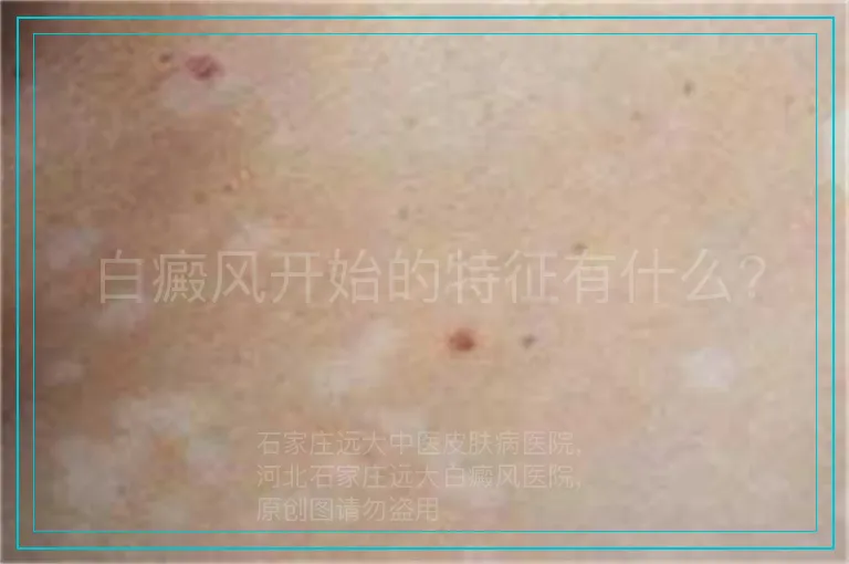 白癜风开始的特征有什么?
