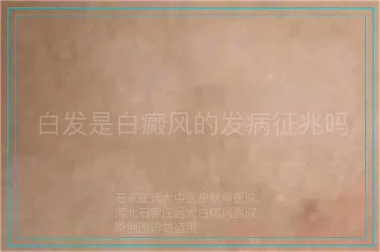 白发是白癜风的发病征兆吗