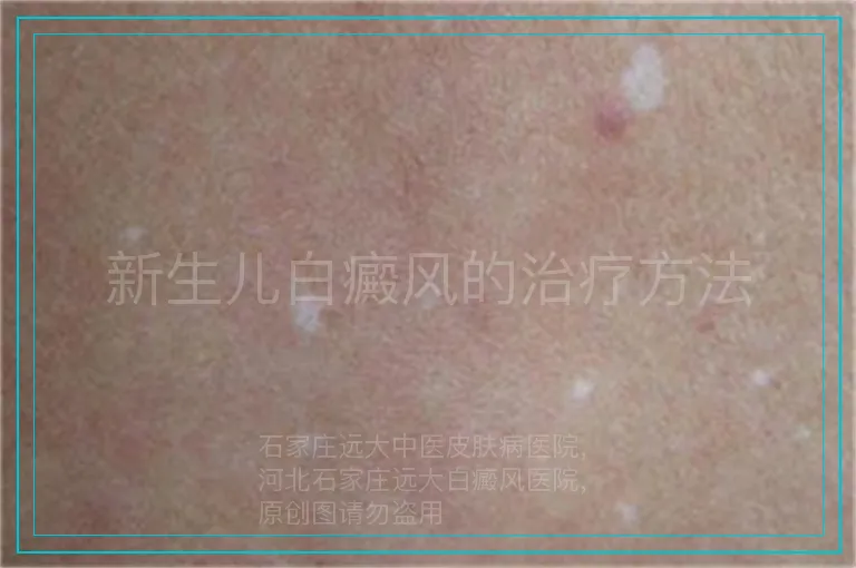 新生儿白癜风的治疗方法