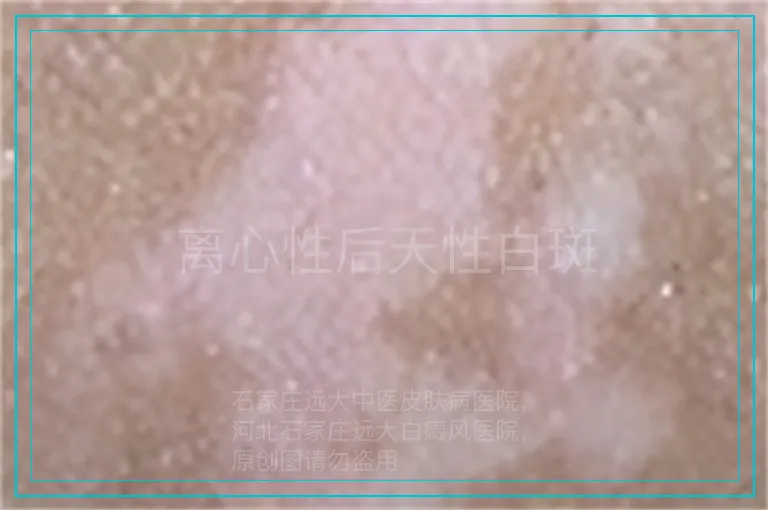 离心性后天性白斑