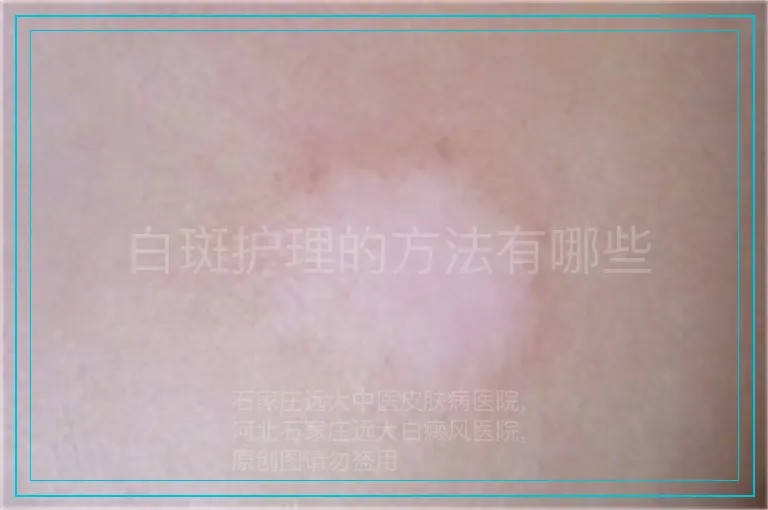 白斑护理的方法有哪些