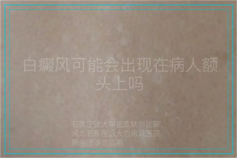 白癜风可能会出现在病人额头上吗